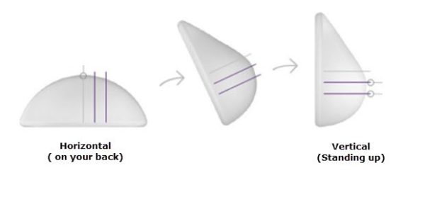 breaat implant shapes